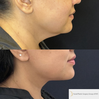 SG-49-y.o-female-who-is-6-months-out-from-Deep-Plane-Facelift-and-Necklift-1-2