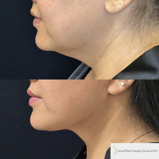 SG-49-y.o-female-who-is-6-months-out-from-Deep-Plane-Facelift-and-Necklift-1-3