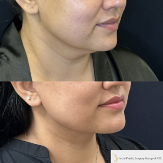 SG-49-y.o-female-who-is-6-months-out-from-Deep-Plane-Facelift-and-Necklift-1-4