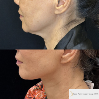 SM-61-y.o-female-6-months-after-Deep-Plane-Facelift-Necklift-1-1