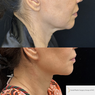 SM-61-y.o-female-6-months-after-Deep-Plane-Facelift-Necklift-1-2