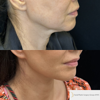 SM-61-y.o-female-6-months-after-Deep-Plane-Facelift-Necklift-1-3