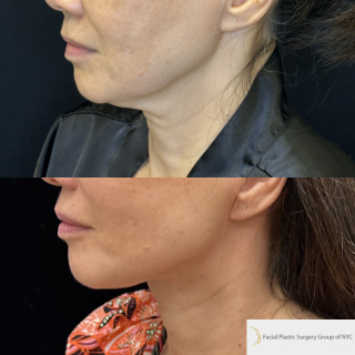 SM-61-y.o-female-6-months-after-Deep-Plane-Facelift-Necklift-1-4