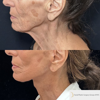 SS-76-y.o-female-who-is-3-months-out-from-Deep-Plane-Facelift-Necklift-Facial-Fat-Transfer-and-CO2-laser-resurfacing-1-1