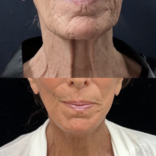 SS-76-y.o-female-who-is-3-months-out-from-Deep-Plane-Facelift-Necklift-Facial-Fat-Transfer-and-CO2-laser-resurfacing-1-2