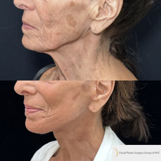 SS-76-y.o-female-who-is-3-months-out-from-Deep-Plane-Facelift-Necklift-Facial-Fat-Transfer-and-CO2-laser-resurfacing-1-3