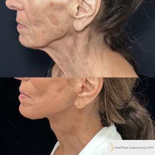 SS-76-y.o-female-who-is-3-months-out-from-Deep-Plane-Facelift-Necklift-Facial-Fat-Transfer-and-CO2-laser-resurfacing-1-4