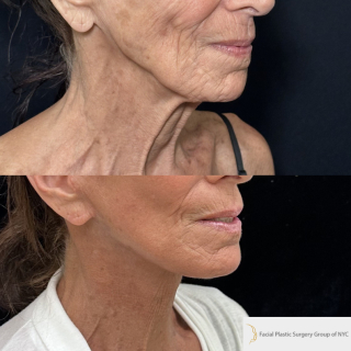 SS-76-y.o-female-who-is-3-months-out-from-Deep-Plane-Facelift-Necklift-Facial-Fat-Transfer-and-CO2-laser-resurfacing-1-5