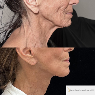 SS-76-y.o-female-who-is-3-months-out-from-Deep-Plane-Facelift-Necklift-Facial-Fat-Transfer-and-CO2-laser-resurfacing-1-6