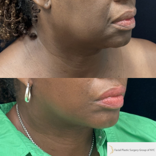 UB-65-y.o-patient-who-is-now-3-months-out-from-Deep-Plane-Facelift-and-Necklift-1-1