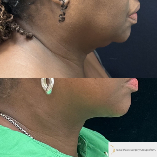 UB-65-y.o-patient-who-is-now-3-months-out-from-Deep-Plane-Facelift-and-Necklift-1-2