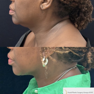 UB-65-y.o-patient-who-is-now-3-months-out-from-Deep-Plane-Facelift-and-Necklift-1-3