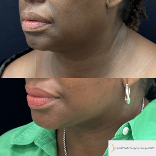 UB-65-y.o-patient-who-is-now-3-months-out-from-Deep-Plane-Facelift-and-Necklift-1-4