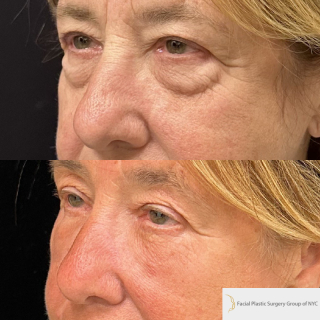 PD-67-y.o-female-who-is-1-month-out-from-Transconjuctival-Lower-Blepharoplasty-and-Facial-Fat-Transfer-1-1