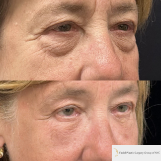 PD-67-y.o-female-who-is-1-month-out-from-Transconjuctival-Lower-Blepharoplasty-and-Facial-Fat-Transfer-1-2