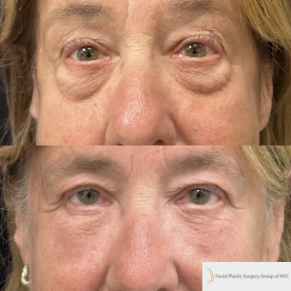 PD-67-y.o-female-who-is-1-month-out-from-Transconjuctival-Lower-Blepharoplasty-and-Facial-Fat-Transfer-1-3