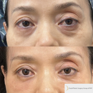 YF-52-y.o-female-who-is-3-months-out-from-Transconjuctival-Lower-Blepharoplasty-1-1