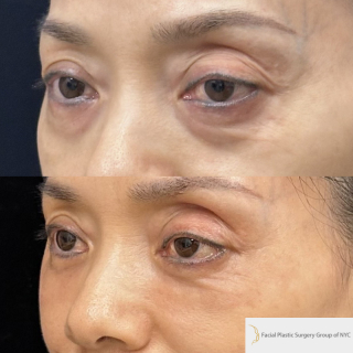 YF-52-y.o-female-who-is-3-months-out-from-Transconjuctival-Lower-Blepharoplasty1-2