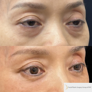 YF-52-y.o-female-who-is-3-months-out-from-Transconjuctival-Lower-Blepharoplasty1-3