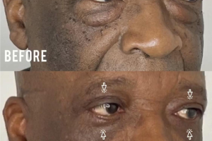72-y.o-male-who-underwent-upper-and-lower-blepharoplasty-1