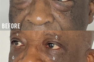 72-y.o-male-who-underwent-upper-and-lower-blepharoplasty-2