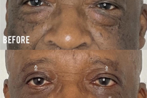 72-y.o-male-who-underwent-upper-and-lower-blepharoplasty-3