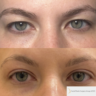 DR-35-y.o-female-who-is-3-months-out-from-Upper-Blepharoplasty-1-1