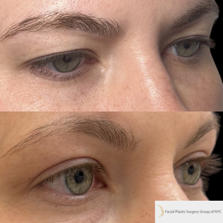 DR-35-y.o-female-who-is-3-months-out-from-Upper-Blepharoplasty-1-2