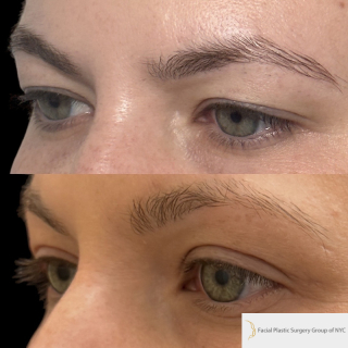 DR-35-y.o-female-who-is-3-months-out-from-Upper-Blepharoplasty-1-3