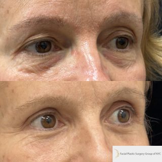 ET-58-y.o-patient-who-is-3-months-out-from-Upper-Blepharoplasty-Lower-Blepharoplasty-and-Facial-Fat-Transfer-1-1