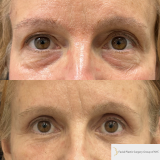 ET-58-y.o-patient-who-is-3-months-out-from-Upper-Blepharoplasty-Lower-Blepharoplasty-and-Facial-Fat-Transfer-1-2