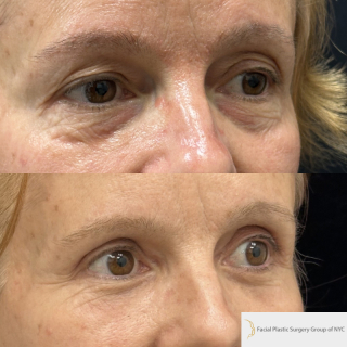 ET-58-y.o-patient-who-is-3-months-out-from-Upper-Blepharoplasty-Lower-Blepharoplasty-and-Facial-Fat-Transfer-1-4