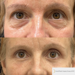 ET-58-y.o-patient-who-is-3-months-out-from-Upper-Blepharoplasty-Lower-Blepharoplasty-and-Facial-Fat-Transfer-1-5