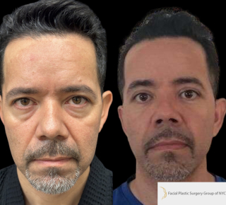 SO-47-y.o-male-who-is-3-months-out-from-Upper-Blepharoplasty-Lower-Blepharoplasty-and-Facial-Fat-Transfer-1-1