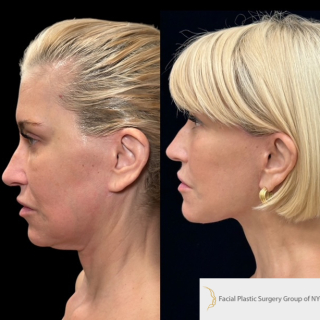 female-with-deep-plane-facelift