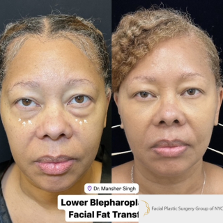 female-with-lower-blepharoplasty-facial-fat-transfer