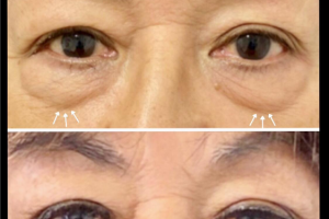 67-y.o-female-who-underwent-transconjuctival-lower-blepharoplasty-with-skin-pinch-1