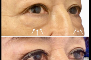 67-y.o-female-who-underwent-transconjuctival-lower-blepharoplasty-with-skin-pinch-2