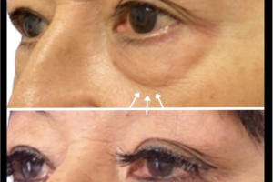 67-y.o-female-who-underwent-transconjuctival-lower-blepharoplasty-with-skin-pinch-3