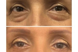 52-y.o-female-who-underwent-transconjuctival-lower-blepharoplasty-with-skin-pinch-1