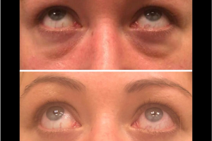 40-y.o-female-who-underwent-transconjuctival-lower-blepharoplasty-with-skin-pinch-1