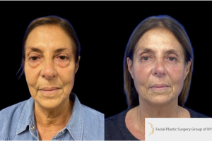 72-y.o-female-who-underwent-transconjuctival-lower-blepharoplasty-with-skin-pinch-172-y.o-female-who-underwent-transconjuctival-lower-blepharoplasty-with-skin-pinch-1