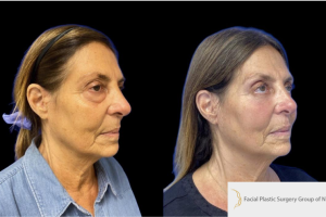 72-y.o-female-who-underwent-transconjuctival-lower-blepharoplasty-with-skin-pinch-2