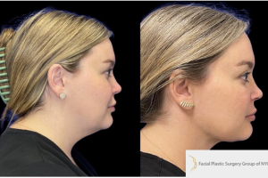 30-y.o-female-who-underwent-liposculpting-of-her-chin-and-neck-1