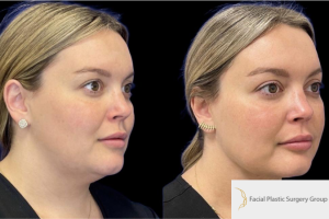 30-y.o-female-who-underwent-liposculpting-of-her-chin-and-neck-2