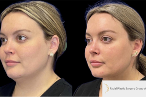 30-y.o-female-who-underwent-liposculpting-of-her-chin-and-neck-3