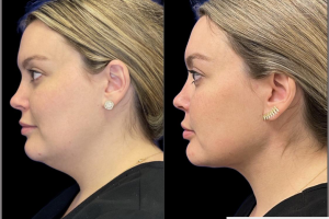 30-y.o-female-who-underwent-liposculpting-of-her-chin-and-neck-4