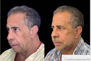 Deep-Plane-Facelift-and-Extended-Deep-plane-Neck-Lift-1