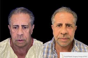 Deep-Plane-Facelift-and-Extended-Deep-plane-Neck-Lift-2