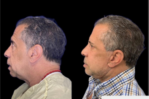 Deep-Plane-Facelift-and-Extended-Deep-plane-Neck-Lift-4
